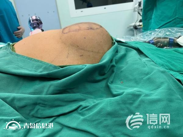 勿以“疝”小而不為 專家建議：及早干預(yù)才是明智之選